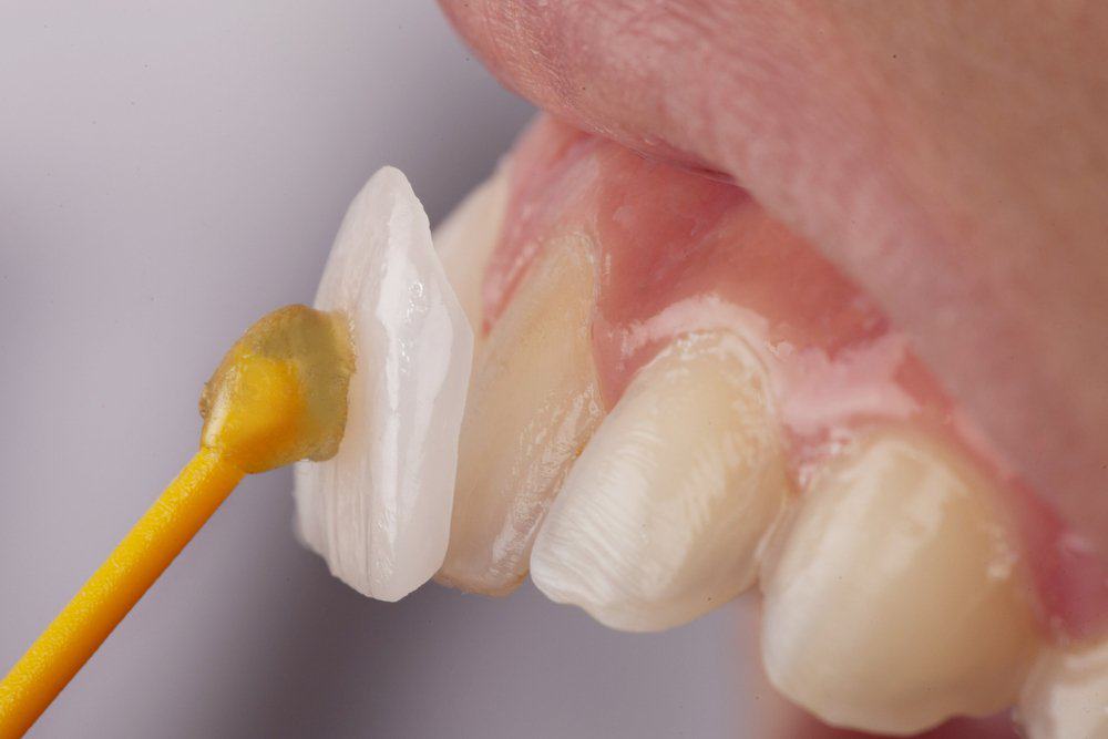 Why Do Dental Crowns Fail or Get Damaged Prematurely England?