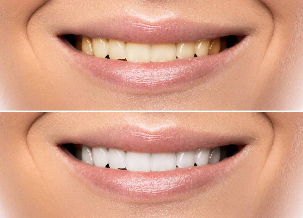 How Can You Protect Your White Smile as a Coffee Lover England?