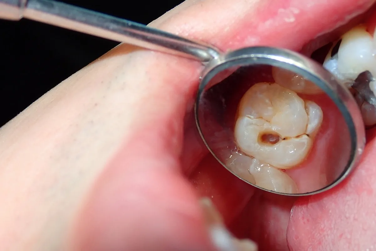 Why Do Teeth Crack? Common Causes to Know England