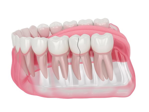 How Can You Manage Pain and Discomfort After a Root Canal England?