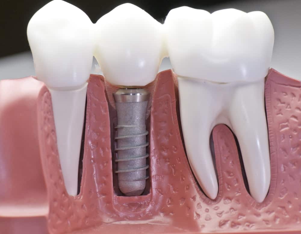 Who Is a Good Candidate for Dental Implants England?
