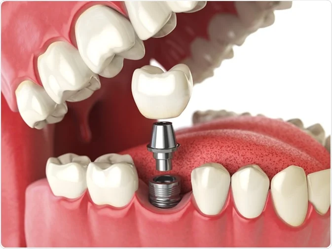 How Do I Decide Which Tooth Replacement Is Right for Me England?