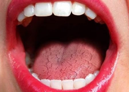 Dry Mouth and Its Role in Tooth Decay England