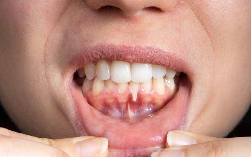 How Can Gum Disease Be Prevented England?