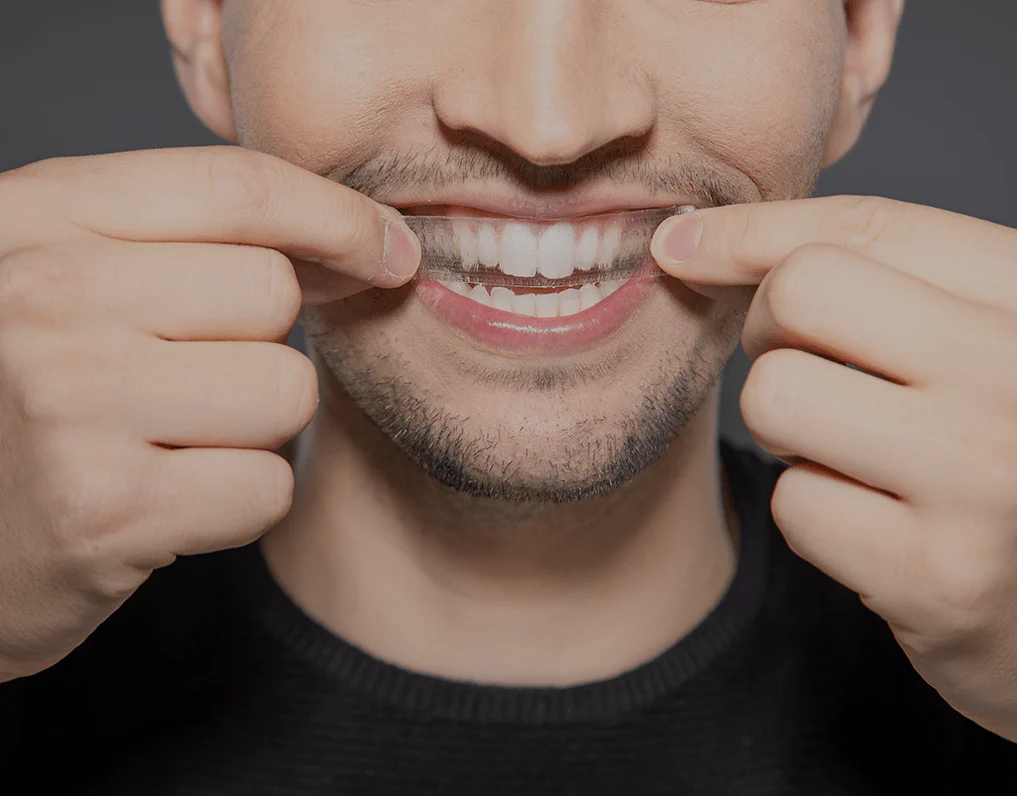 Can You Whiten Natural Teeth Without Harsh Chemicals England?