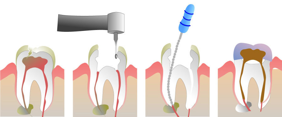 How Do You Properly Care for Your Teeth After a Root Canal England