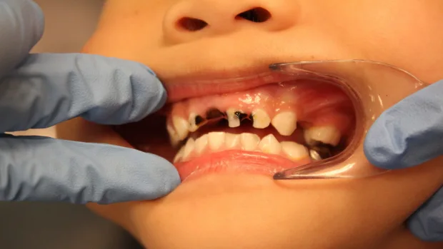 Which Foods and Drinks Cause the Most Damage to Young Smiles England?