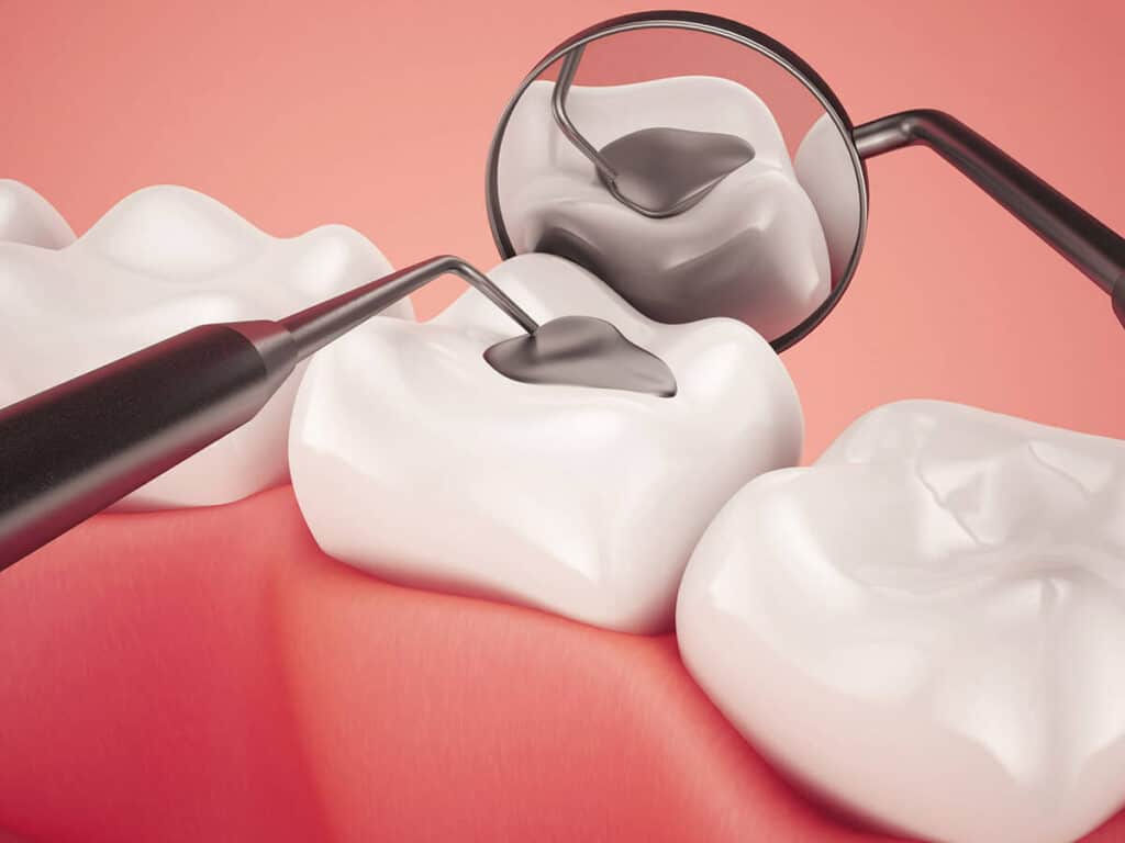 Fighting Cavities and Plaque Buildup England