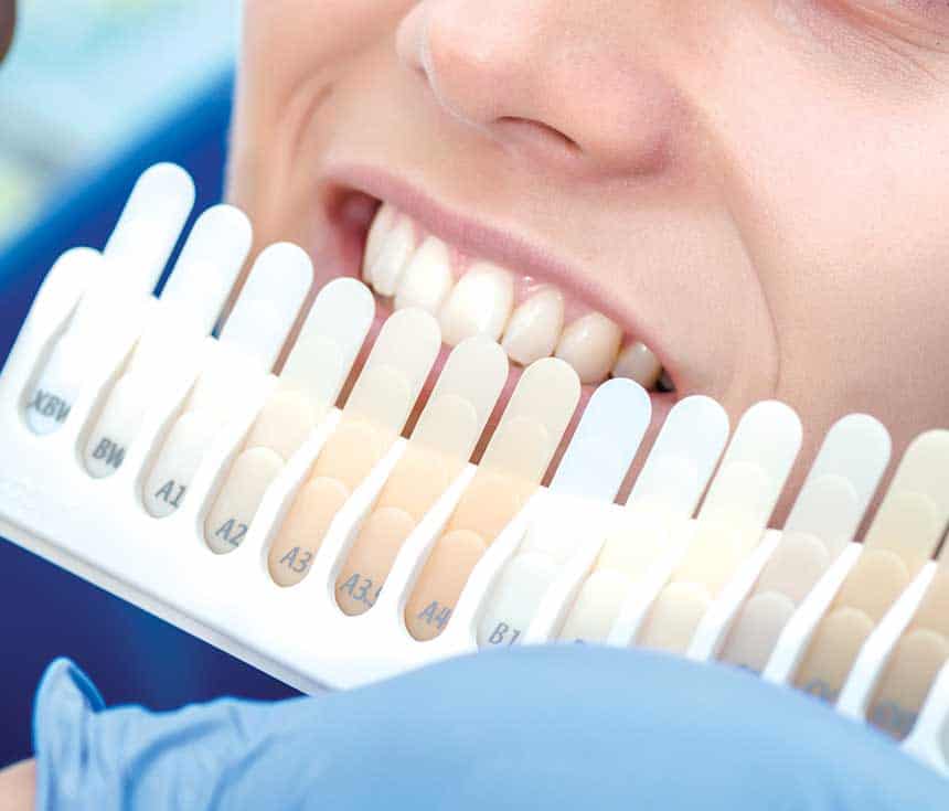 Professional vs At-Home Whitening: What You Need to Know England