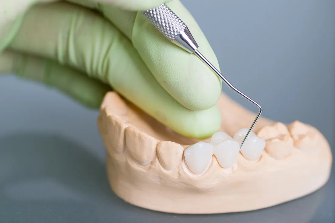 Do Braces Take Years to Show Results England