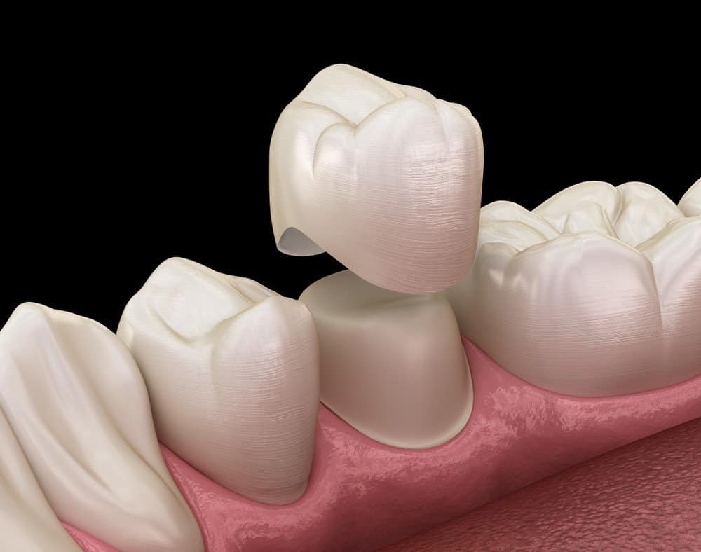 How Can You Prevent Common Dental Crown Problems England?