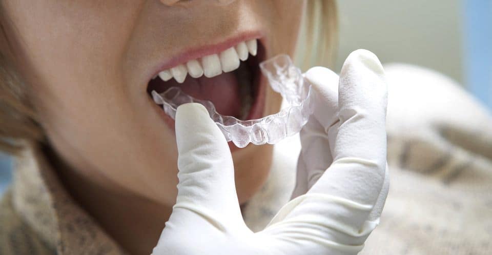 How Much Does Laser Teeth Whitening Cost Compared to Overnight Trays England?